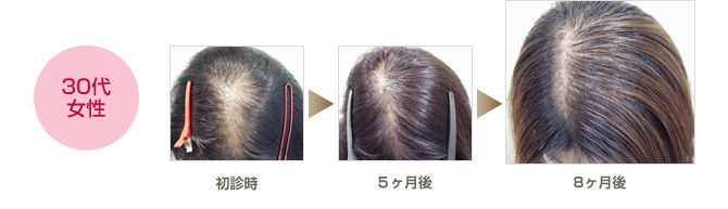 女性の薄毛を改善した症例をご紹介します 薄毛 Aga治療のあれこれ Dクリニック大阪 メンズ 旧脇坂クリニック大阪 の頭髪コラム 女性の薄毛を改善した症例をご紹介します 薄毛 Aga治療のあれこれ Dクリニック大阪 メンズ 旧脇坂クリニック大阪 の頭髪コラム