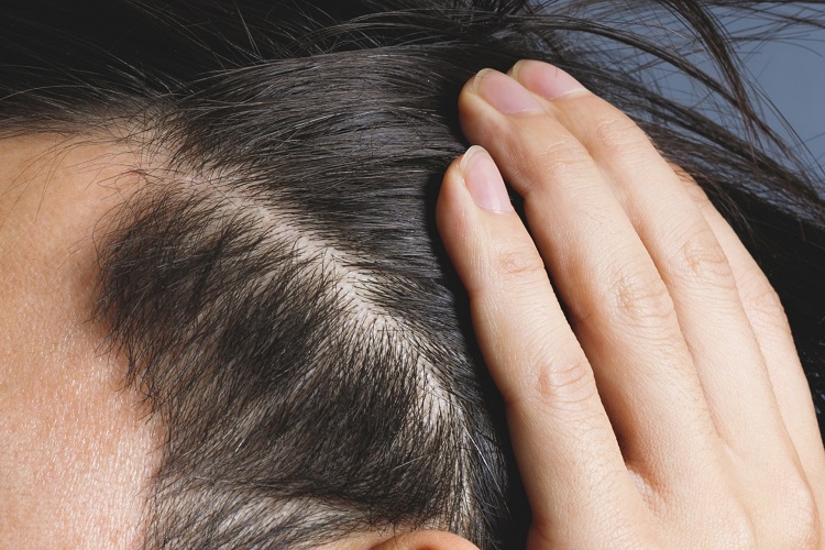 分け目 はげ 髪の毛 分け目が薄い、地肌が目立つ ～原因と対策