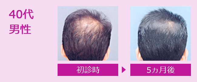 薄毛治療 男性