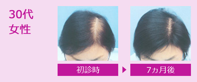 薄毛治療 女性